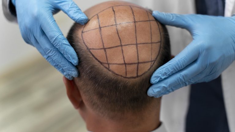 Greffe de cheveux FUT : la solution pour retrouver une chevelure dense !