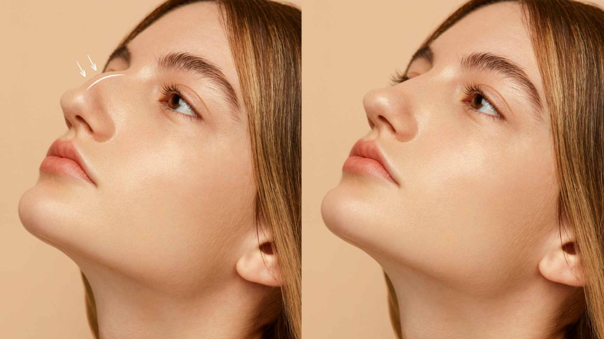 Rhinoplastie : retrouvez un profil harmonieux et naturel !